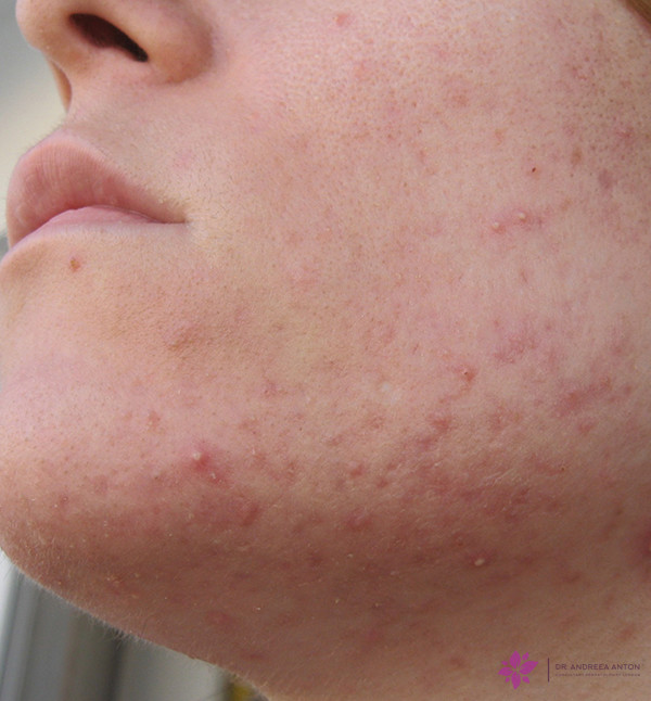 hormonal acne solutions to treat acne