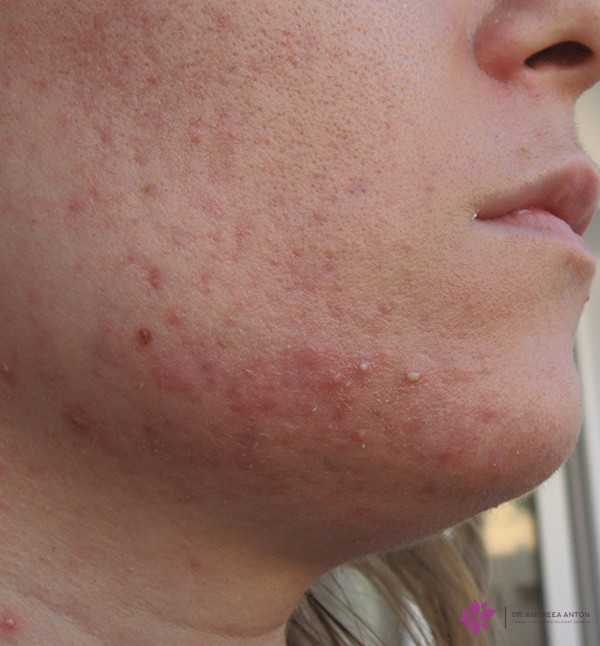 face acne before solutions to treat acne treatment