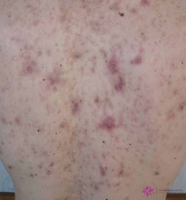 cystic acne back Solutions to treat acne