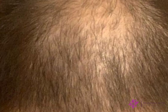 Androgenetic alopecia in men male baldness