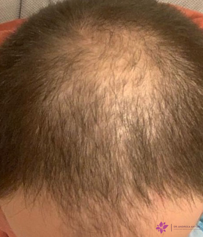 Androgenetic alopecia in men male baldness