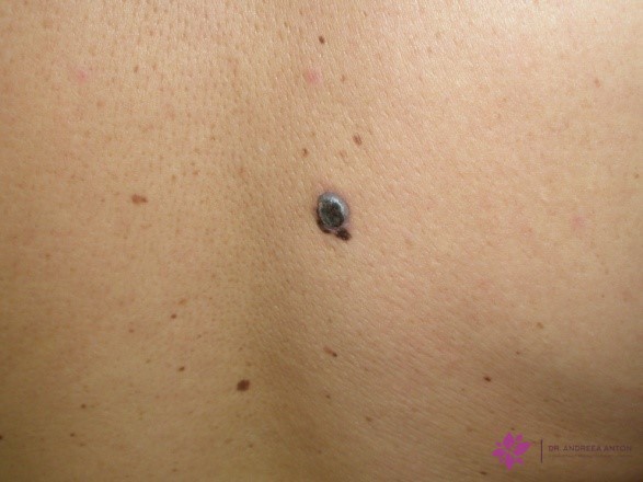 nodular melanoma skin cancer