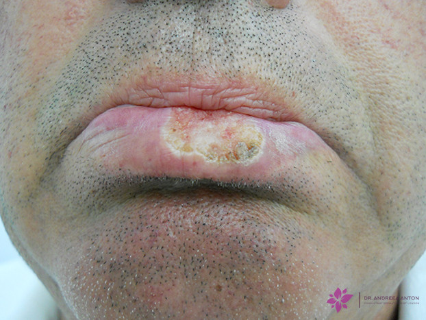 Squamous Cell Carcinoma SCC skin cancer