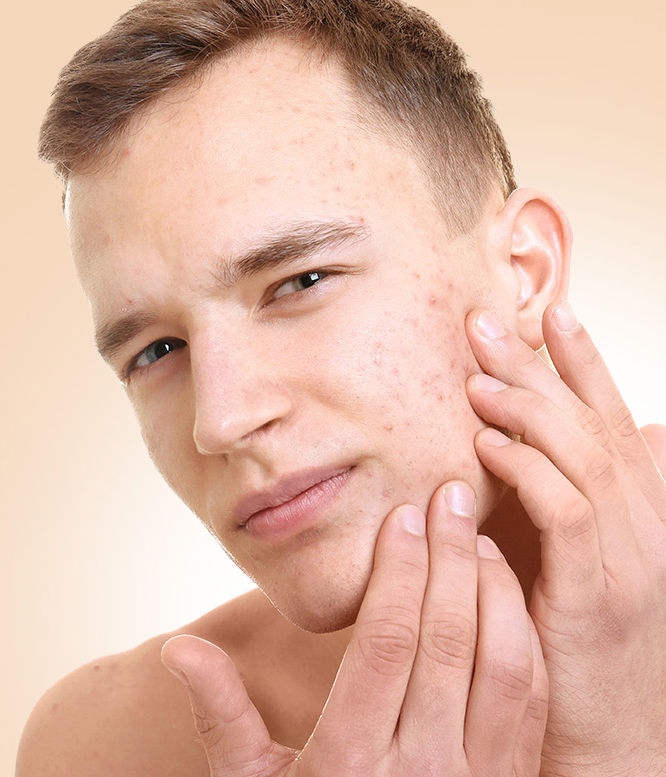 face acne spots