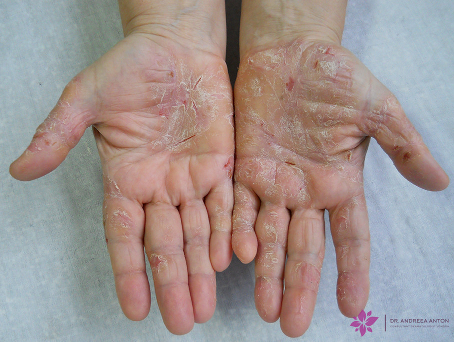 palmoplantar psoriasis hand psoriasis