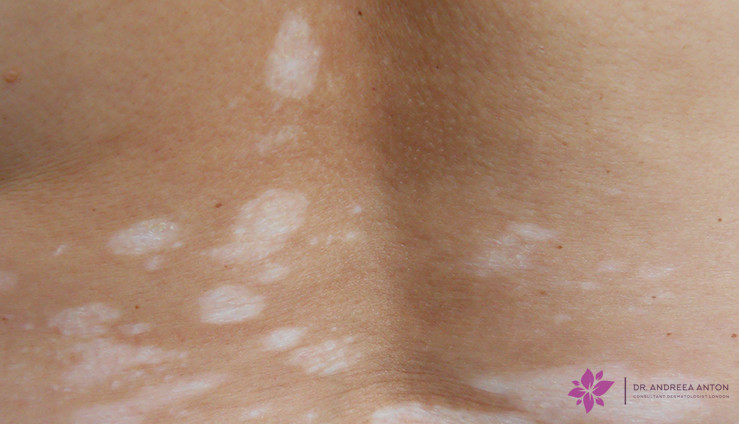 vitiligo loss of pigment depigmented patches