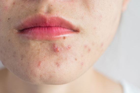 acne mouth face perioral dermatitis